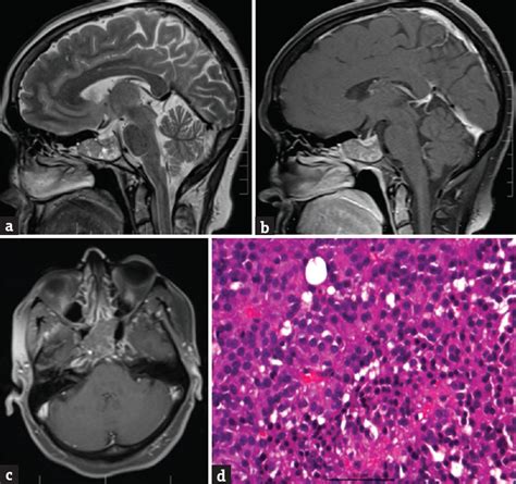 Isolated Sphenoid Sinus Lesions Experience With A Few Rare Pathologies Journal Of