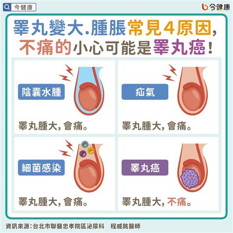 睪丸變大但不會痛？醫教2自檢防睪丸癌：有人腫成像排球。 蕃新聞