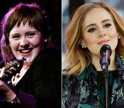 Adele’s Before and After Surgery Photos Show Proof of the Singer’s ...