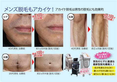 徳島 ヒゲ脱毛 ボディ脱毛 Men S Asc 男性専用メディカルケア