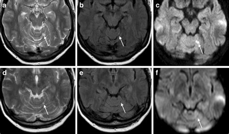 Acute Cerebellar Cortical Infarct Evolving Into An Infarct Cavity Top