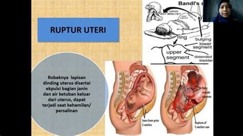 Ruptur Uteri Tanda Gejala Diagnosis Predisposisi Bidanindonesia