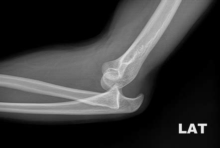 Elbow Dislocation Radiology Reference Article Radiopaedia Org