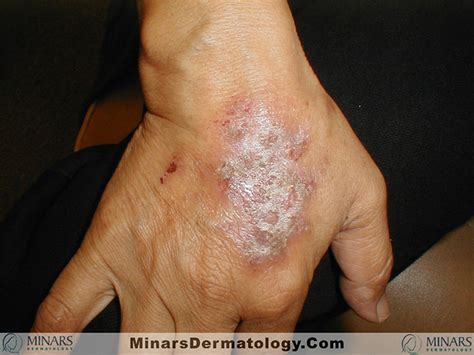 Hand Eczema - Minars Dermatology