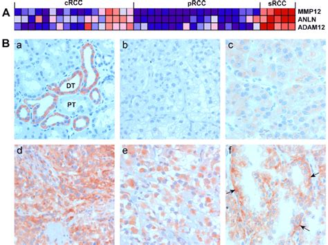 Mmp Expression In Normal Kidney And Renal Cell Carcinoma Rcc A