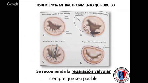 Insuficiencia Mitral Tratamiento Quirurgico Youtube