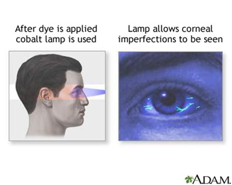 Fluorescein eye stain | UF Health, University of Florida Health