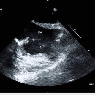 Transthoracic echocardiogram (TTE) ECHO showing a mass in the right... | Download Scientific Diagram