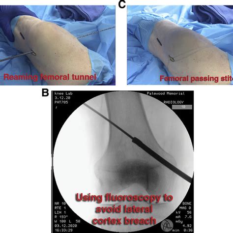 Surgical Steps For Medial Collateral Ligament Reconstruction Using Dual Download Scientific