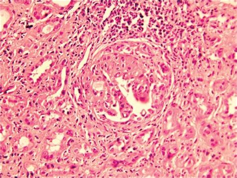 A Glomerulus Showing Fibrocellular Crescents Hande ×150 Download