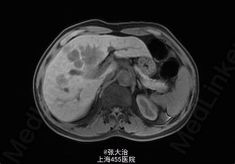 肝内胆管癌 医联