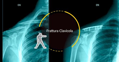 Cooperativa Fuga Amico Di Penna Gonfiore Tra Collo E Clavicola Moschea