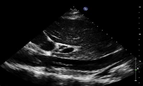 Subcostal view demonstrates a linear echo-dense mass within the IVC ...