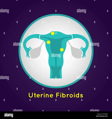 Uterine Fibroids Stock Vector Images Alamy