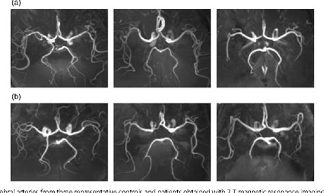 Figure 1 from Lenticulostriate Arteries in Chronic Stroke Patients ...