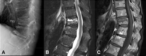 Osteoporosis Vertebral Fracture