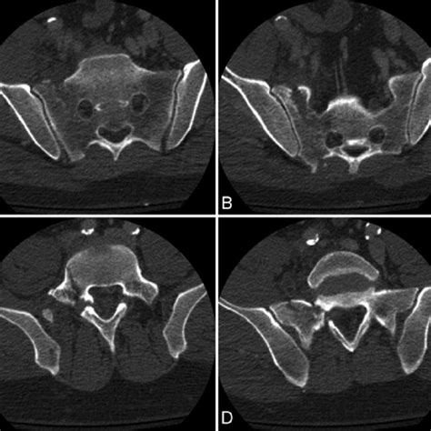 The Denis Classification Of Sacral Fractures A The 3 Zones Zone I Download Scientific