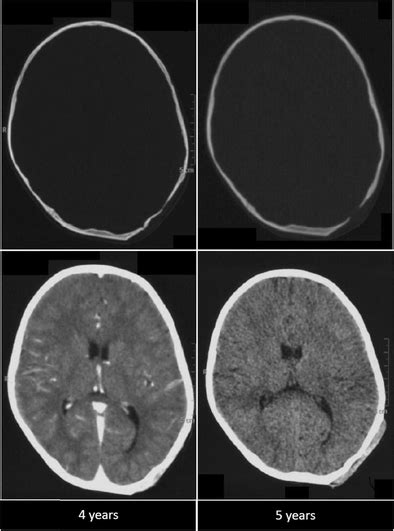 Comparison Ct Scans At A 1 Year Interval Showing An Increase In The Download Scientific Diagram