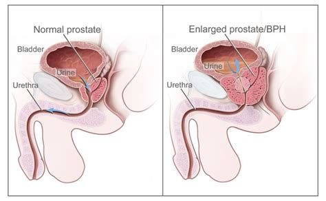 Prostate Cancer Prevention - NCI