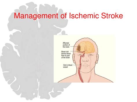 PPT Care Of The Stroke Patient Improving Patient Outcomes PowerPoint