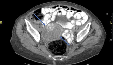 Pelvic Computed Tomography Image A Solid Mass 8 6 Cm In Long