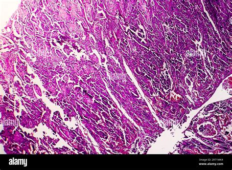 L Ad Nocarcinome Peu Diff Renci De La Lumi Re Intestinale