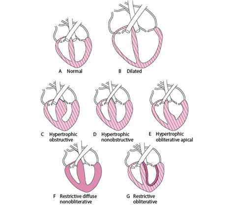 Image Forms Of Cardiomyopathy Msd Manual Professional Edition