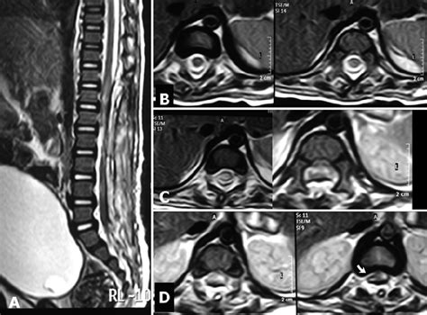 Postoperative Mri A Sagittal T2 Weighted Image Showing Evidence Of Download Scientific