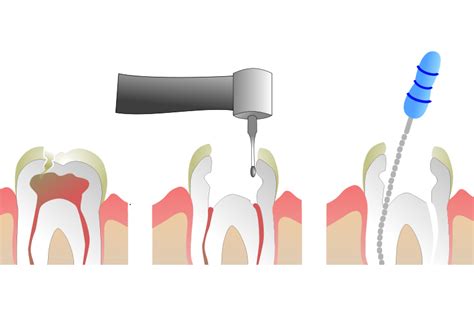 Endodoncia Qué es MVP Dental Móstoles y Getafe