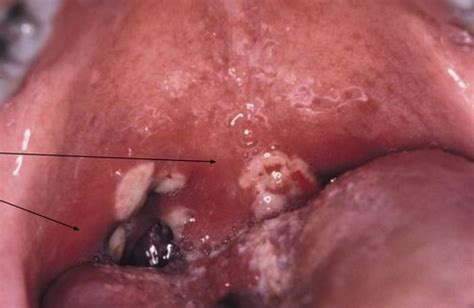 Oral Path I Exam 2 Lesion Pictures Flashcards Quizlet