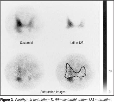 Figure From Unilateral Surgery For Primary Hyperparathyroidism On The