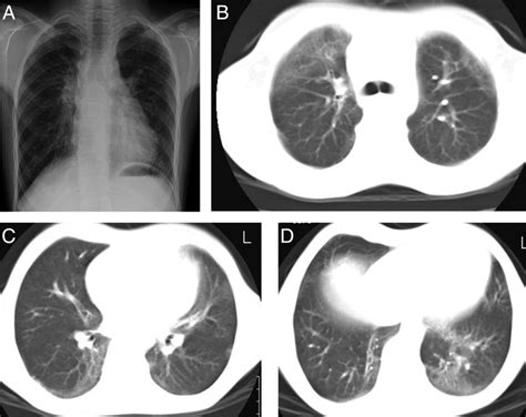 A, Bilateral perihilar and peribronchial interstitial infiltrations on... | Download Scientific ...