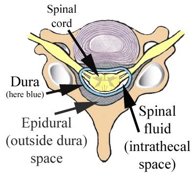 Epidural Steroid Injections: Risk vs Benefit - Spinal CSF Leak Foundation