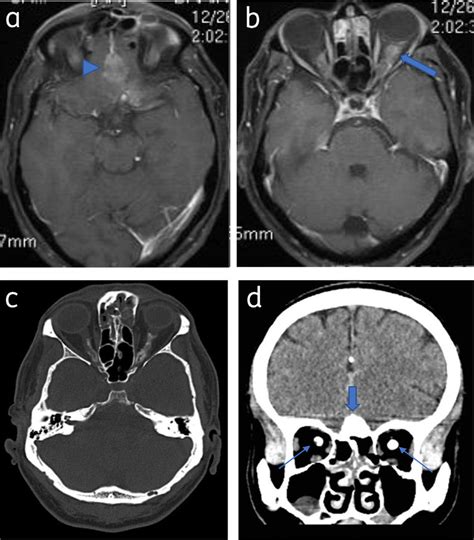 Optic nerve sheath meningioma and olfactory meningioma: Axial post ...