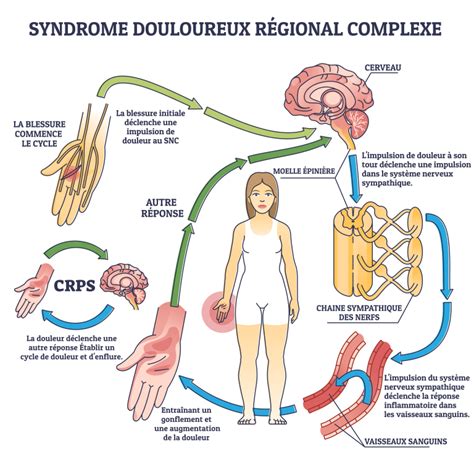 Algodystrophie causes symptômes et traitements Information