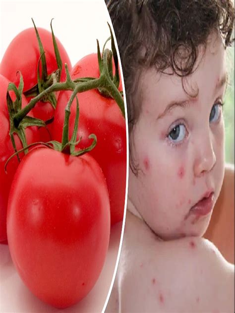 Tomato Flu Symptoms And Treatment Tomato Fever