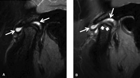 Juvenile Rheumatoid Arthritis Jaw