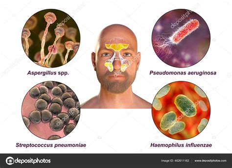 Rinosinusitis Microorganismos Que Causan Sinusitis Hongos Aspergillus