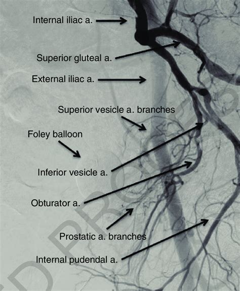 Pelvic Arterial Anatomy Angiogram Human Anatomy