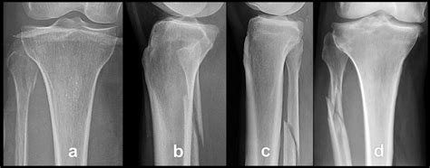 Type Of Proximal Fibular Ractures A Fracture Of Fibular Head B Upper