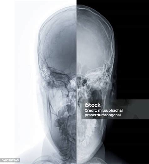 Xray Image Of Human Skull Towns View For Diagnosis Skull Fracture Isolated On Black Background ...