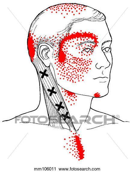 Sternocleidomastoid M Trigger Points Clip Art Mm106011 Akupresur