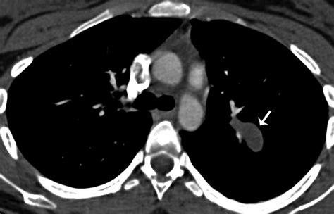 Bronchial Atresia Radiographics