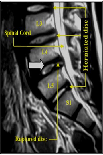 Figure Sagittal Section Of Lumbar Mri T Showing The Appearance Of 36075 Hot Sex Picture