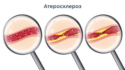 Стенокардия причины симптомы диагностика и лечение