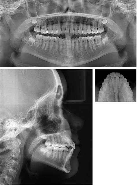 Posttreatment Panoramic Radiograph Lateral Cephalogram And Occlusal Download Scientific