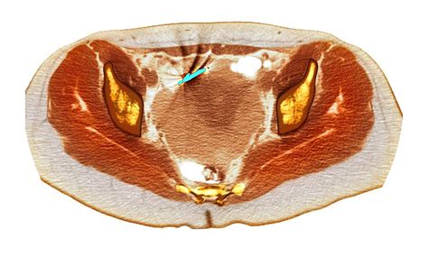 Ectopic Iud Contraceptive Ct Scan Photograph By Du Cane Medical