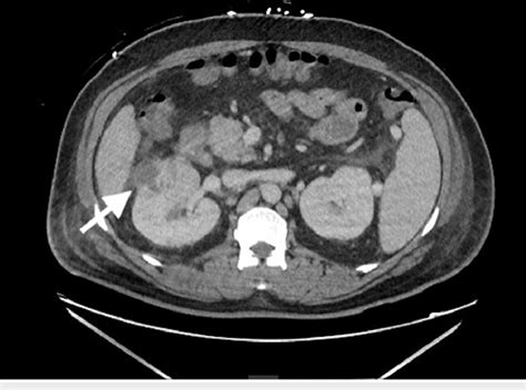 Ct Abdomen And Pelvis Showing A 4 Cm Heterogeneously Enhancing Right