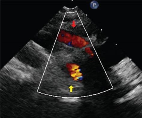 Right Aortic Arch Ultrasound