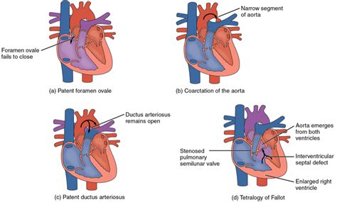 Congenital Heart Disease In Adults 2 Simple Defects Online Learning